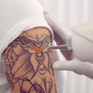 laser tattoo removal course