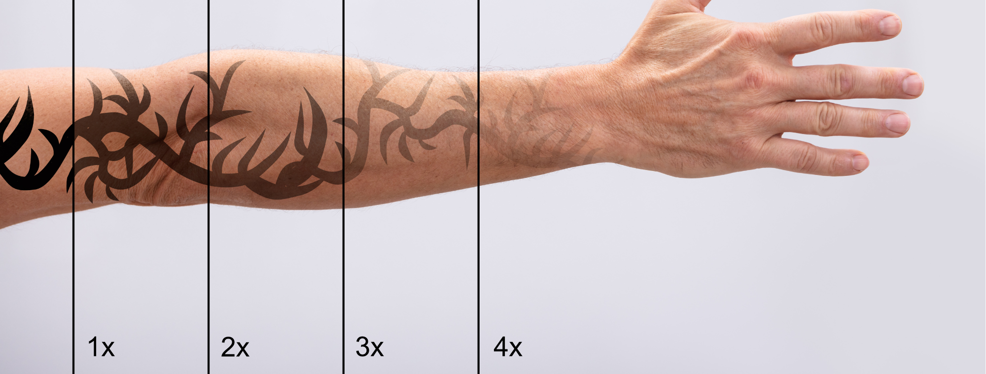 What Exactly Happens During The Laser Tattoo Removal Process?