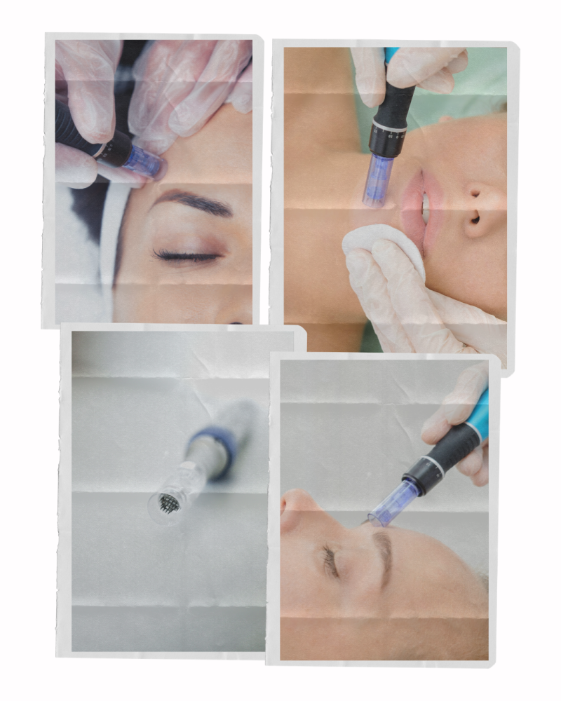 microneedling collage