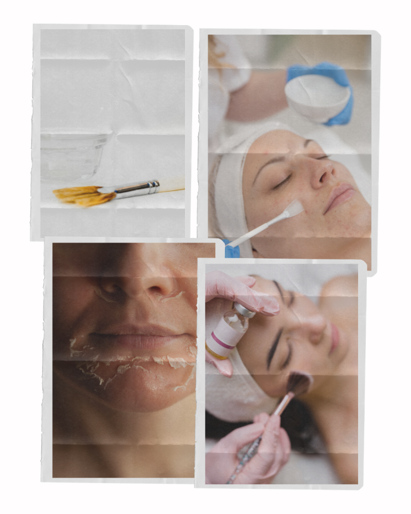 chemical skin peels collage