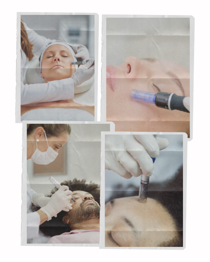 microneedling collage