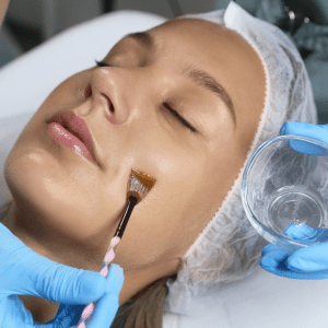 chemical skin peels model receiving a treatment