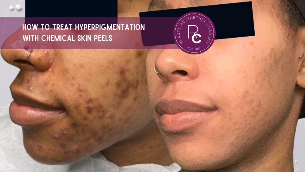 how to treat hyperpigmentation with chemical skin peels