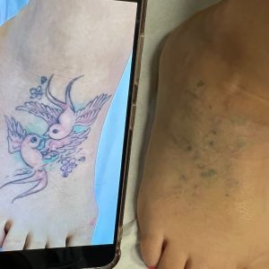 laser tattoo removal results on foot