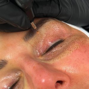 close up of plasma pen treatment on upper and lower eyelid