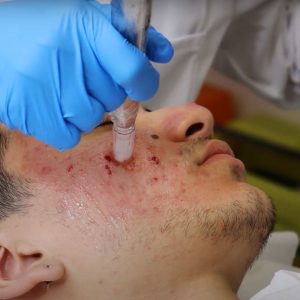 microneedling on acne