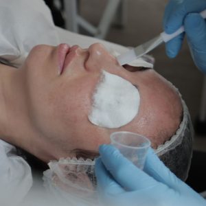 a chemical skin peel treatment