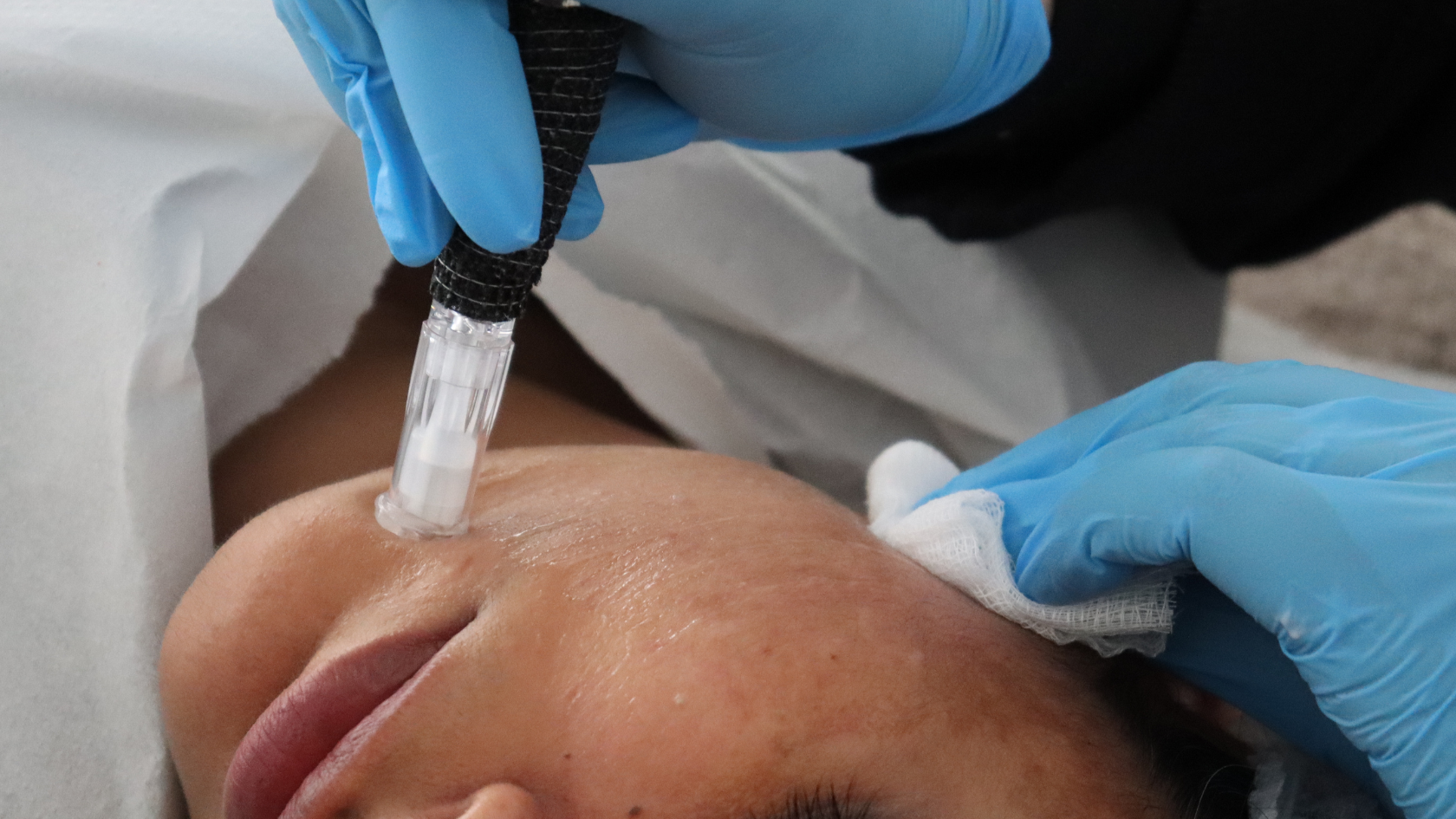 What qualifications do I need to offer microneedling treatment in the UK?