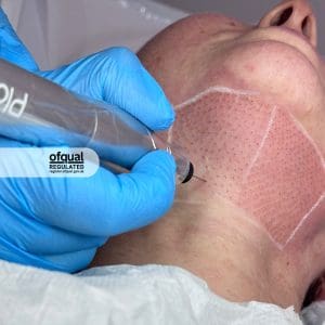 Plasma Pen Treatment on neck