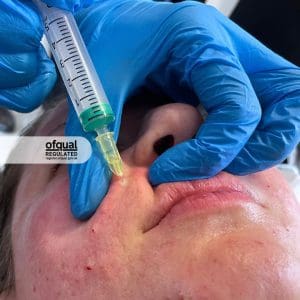 mesotherapy injection on cheeks