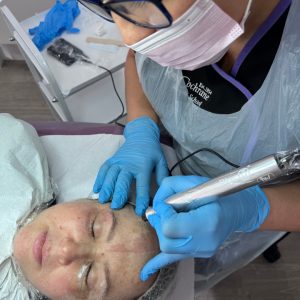 student performing plasma pen treatment on forehead