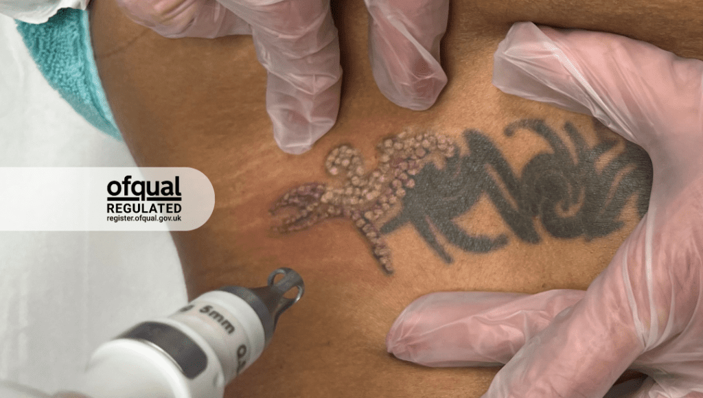 Level 5 Laser Tattoo Removal