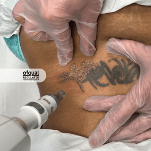 Level 5 Laser Tattoo Removal