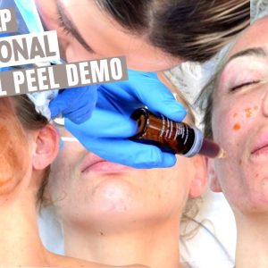 level 4 chemical skin peels